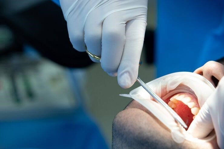 Ošetření kořenových kanálků vícekořenových zubů
